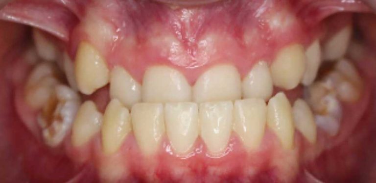 metal-braces-02b