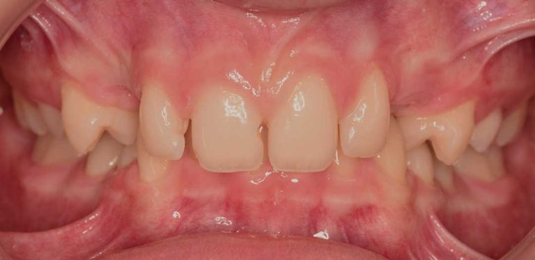 metal-braces-03b