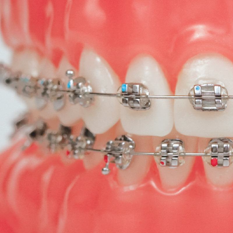Damon Braces 10 traditional braces