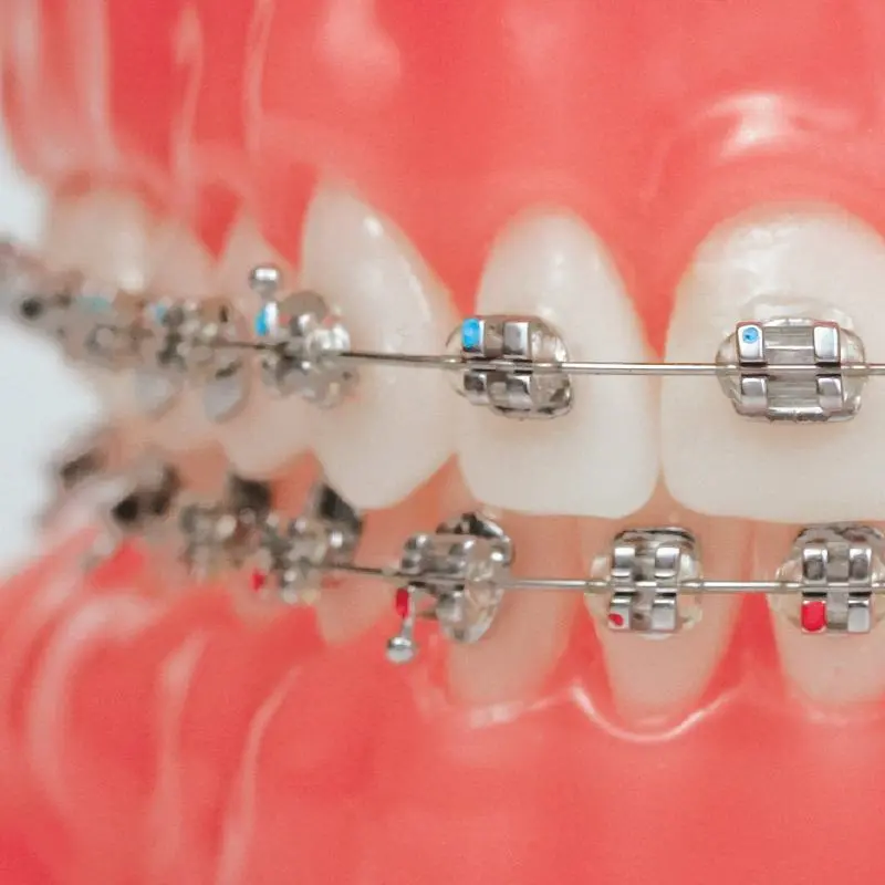 traditional braces