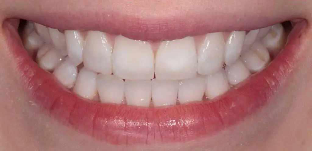 align bleach bond 01a