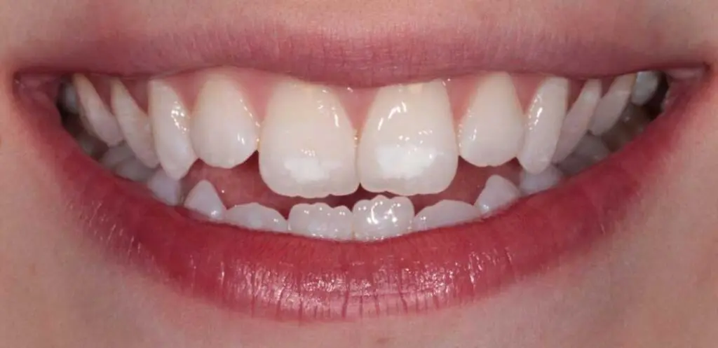 align bleach bond 01b