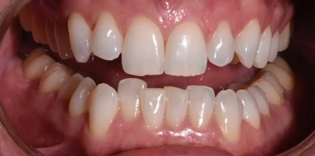 align bleach bond 06b