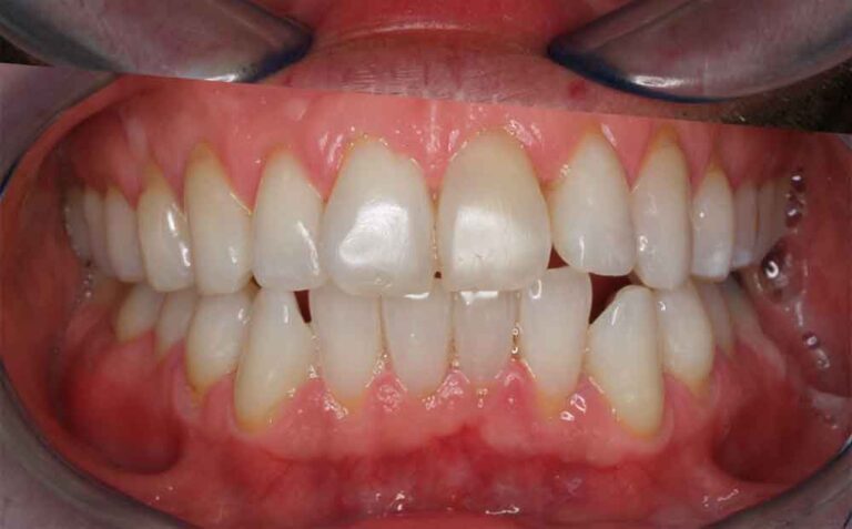 home-teeth-whitening-01a