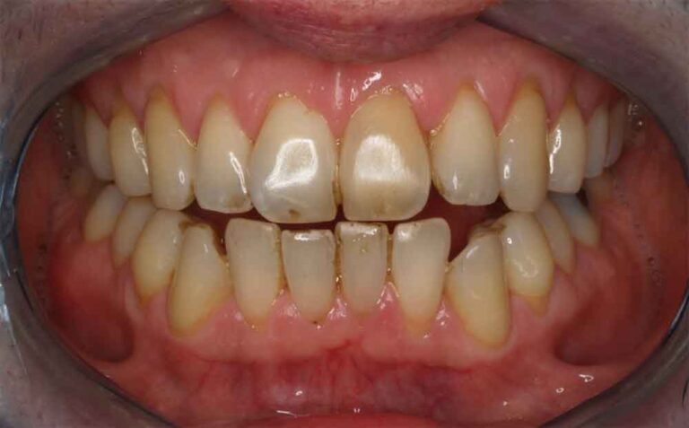 home-teeth-whitening-01b