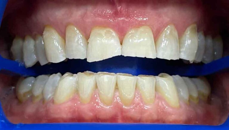 teeth-whitening-01a