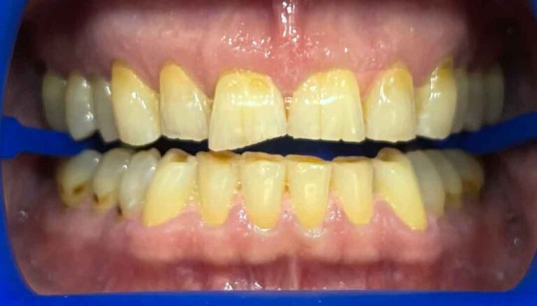 teeth-whitening-01b