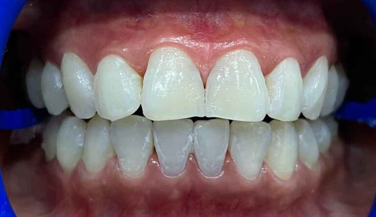 zoom-teeth-whitening-06a