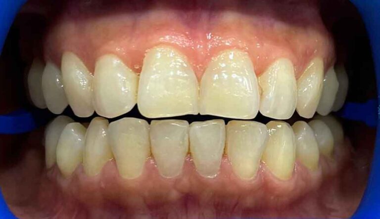 zoom-teeth-whitening-06b