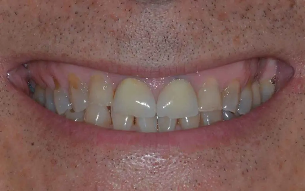 Occlusal Rehabilitation in Dubai - Dental Studio 2 occlusal rehabilitation 01b