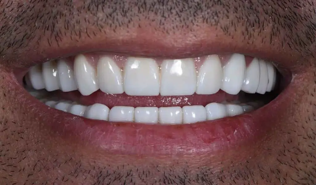 Occlusal Rehabilitation in Dubai - Dental Studio 5 occlusal rehabilitation 04a