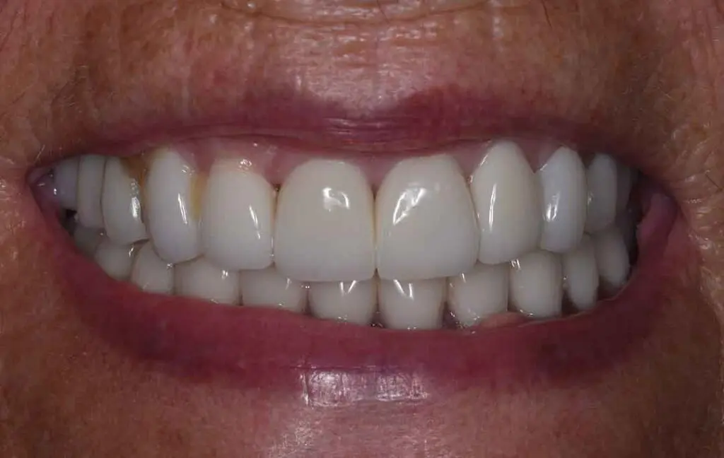 Occlusal Rehabilitation in Dubai - Dental Studio 7 occlusal rehabilitation 05a