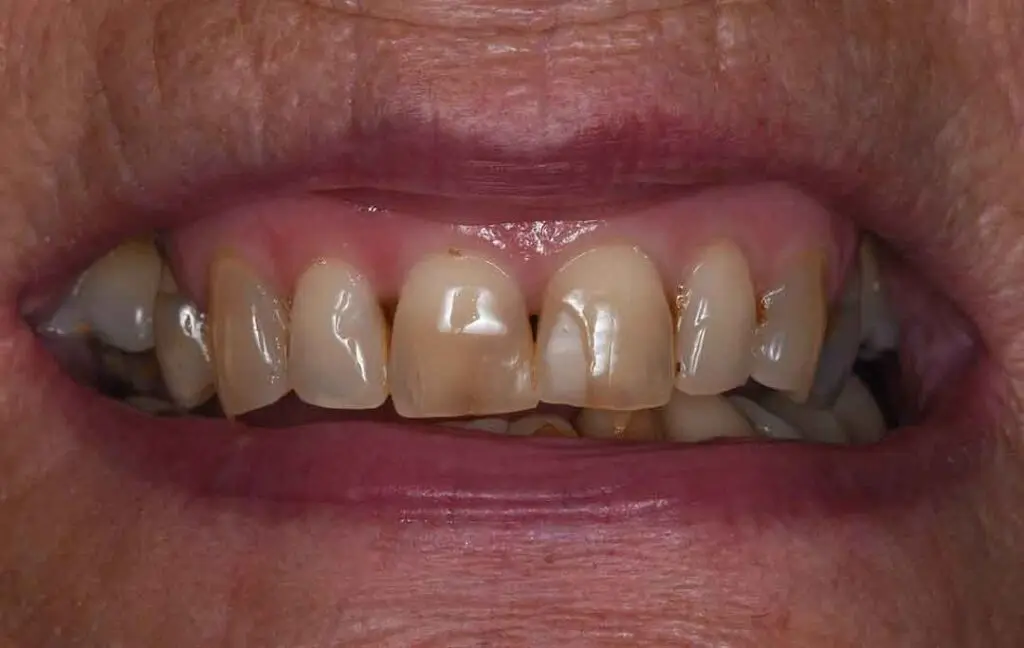 Occlusal Rehabilitation in Dubai - Dental Studio 6 occlusal rehabilitation 05b