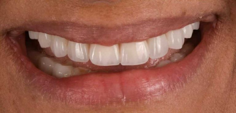 full-mouth-rehabilitation-02a