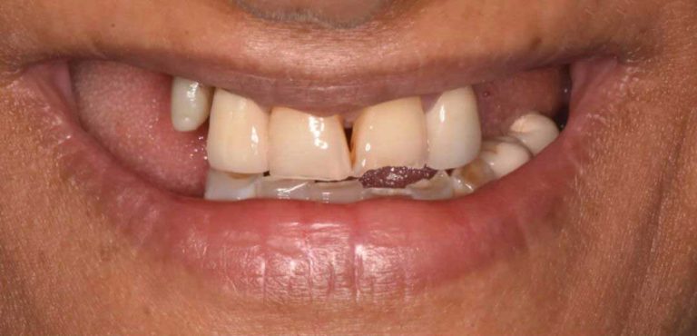 full-mouth-rehabilitation-02b