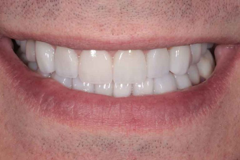 full-mouth-rehabilitation-03a