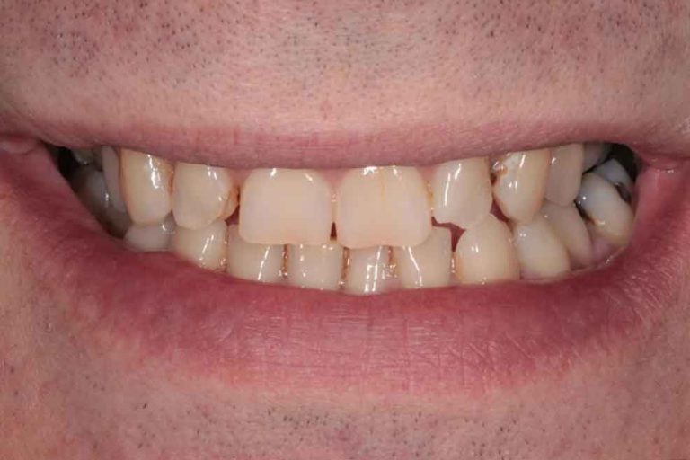 full-mouth-rehabilitation-03b