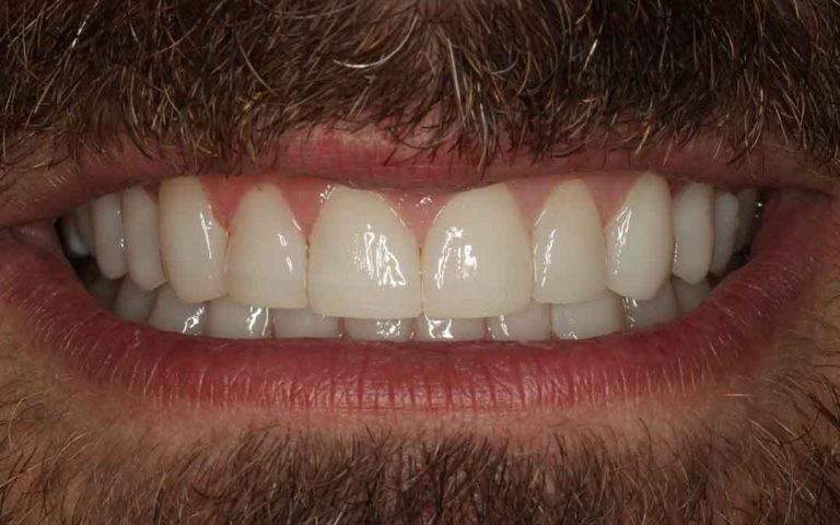 full-mouth-rehabilitation-06a
