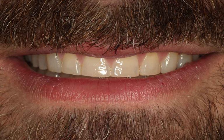 full-mouth-rehabilitation-06b