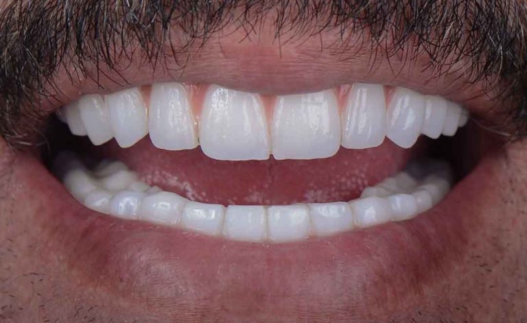 full-mouth-rehabilitation-09a