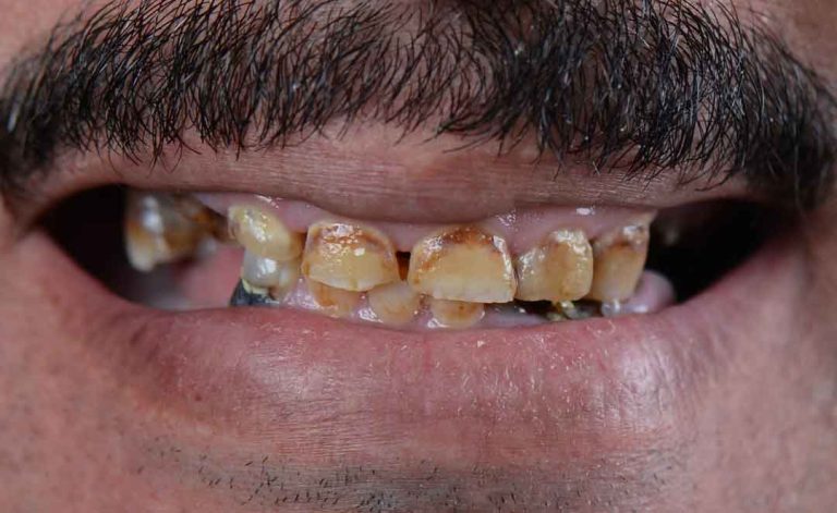 full-mouth-rehabilitation-09b
