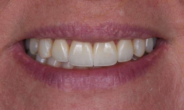 full-mouth-rehabilitation-10a