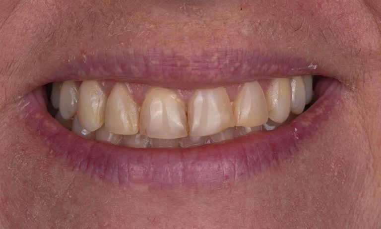 full-mouth-rehabilitation-10b