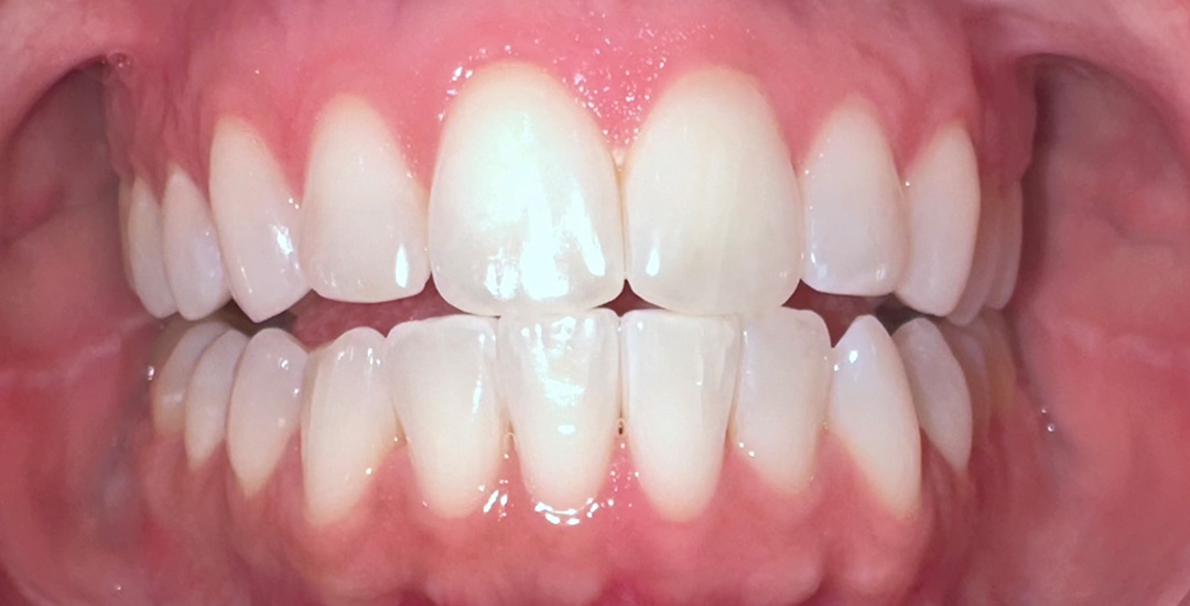 Melody Lynne Schwartz - After