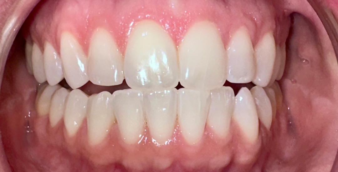 Melody Lynne Schwartz - Before