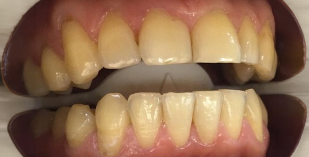 Felicia Bjurfjäll - Before