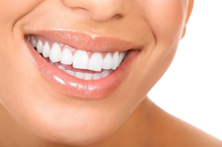 composite bonding vs veneers